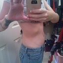 3 months post op.