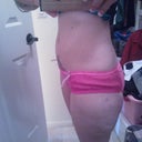 3 months post op.