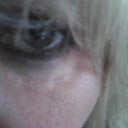 EVOLENCE EYE LUMPS