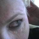 EVOLENCE EYE LUMPS