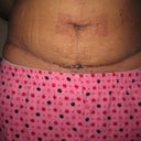 DAY 24 CLOSE UP OF INCISION LINE