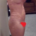 Side photo 2 weeks post op SlimLipo. I had a bubble from my c-section 20 yrs ago.  Belly is almost flat.  LOVE the outcome so far