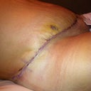 7 days post op and feeling great!
