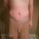 Post Op Day #4 Front (More Swelling)