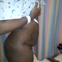 side view of the marks... 30 min  pre op