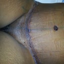 excuse the close up of my little woman here but look at the incison... 1 day post op
