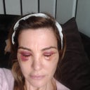 day 3 , tried to add more pics but cant them up for some reason ill try again so you can see the result on week 2 amazing look.