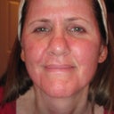 This is the evening of the day after treatment, skin tingly and itchy.
