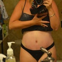 5 days post op. very swollen, pale and bruised.