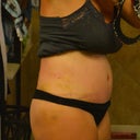 5 days, drainless tt and lipo of flank. very sore, redness from tape and scratching.