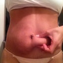 6.5 weeks after procedure