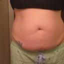 Before - front (the tattoo will be completely gone - talk about 2 for 1!)