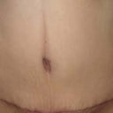 6 weeks post-op.