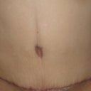 8 weeks post-op.