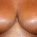 3 Weeks...one side a little swollen...