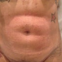 3 day post op front