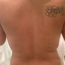 3 day post op back