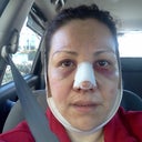Day 1 after surgery