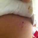 Itchy blisters from the drains
