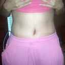 12 days Post op.