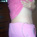 12 Days post op side view
