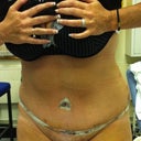 6 day po snatched a photo whilst getting my dressing changed