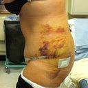6 days po. mega swollen
