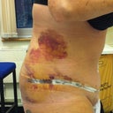 6 days po.... bruising looking pretty bad