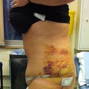 6 days po opposite side and bruising on this side really bad as well