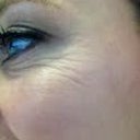 4 days AFTER Botox. - another close up of my left eye so you can compare to the before.