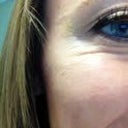 4 days AFTER Botox - so you can compare with the right eye before.