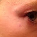 Here is a picture of the tiny bit of bruising I had at the two injection sites on the right eye. Like I said, nothing too big, but thought I'd let you see it. :)