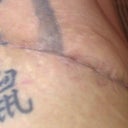 18 days after revision. A bit swollen still.
