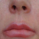 Upper lip after Vitrase