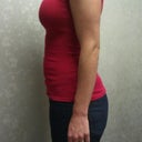 SIDE VIEW 400cc implants... TRYING ON IN OFFICE