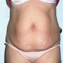 Before front.  My PS says the incision will be under my C-sec. scar which is really low!  Okay notice the tenny tiny red dot to the upper  left of my belly button, before surgery and then look where it is AFTER surgery