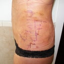 side pic after surgery