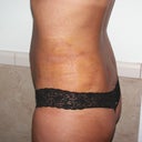 5 days after surgery
