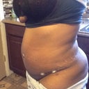 Tummy lipo 2-23-2013
