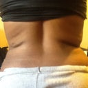 Back lipo 2-23-2013