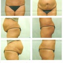 12 Weeks PO, before and after pics