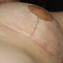 Scars healing well, thanks I am sure to paper-taping