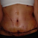 10 days post op tt scar close up. Still has the steri-strip on