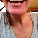 Teeth before. My teeth were actually straight and healthy, but tiny with a very gummy smile.