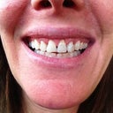 Teeth after crown lengthening surgery at 30 days. The teeth look somewhat misshapen and there are large gaps where the gums were lifted.