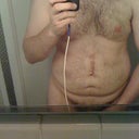 before tummy tuck previous scar from hernia repair