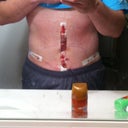 ONE DAY POST OP!!!!  Im so excited.