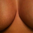 4 Weeks post, cleavage scars