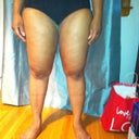 Post op legs - 4 weeks