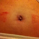 Aug. 26 (4 wks 3 days PO) BB after a shower.  Blob of tissue.